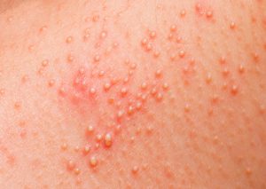Hudsjukdomar och allergiska utslag på kroppen