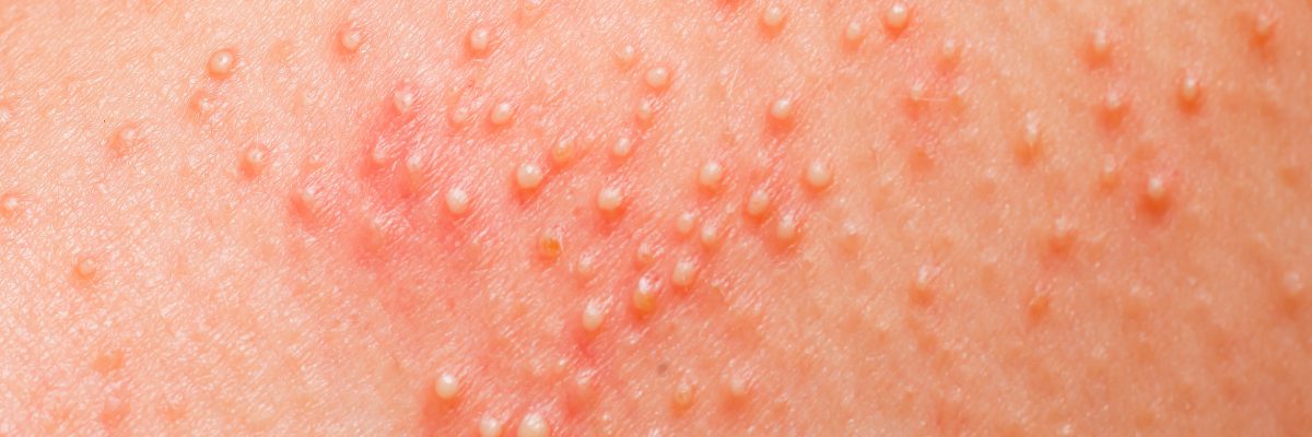 Hudsjukdomar och allergiska utslag på kroppen